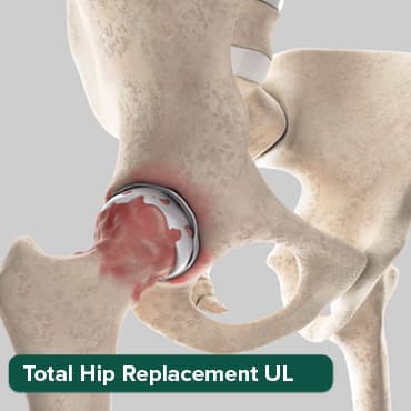 Total Hip Replacement-U/L