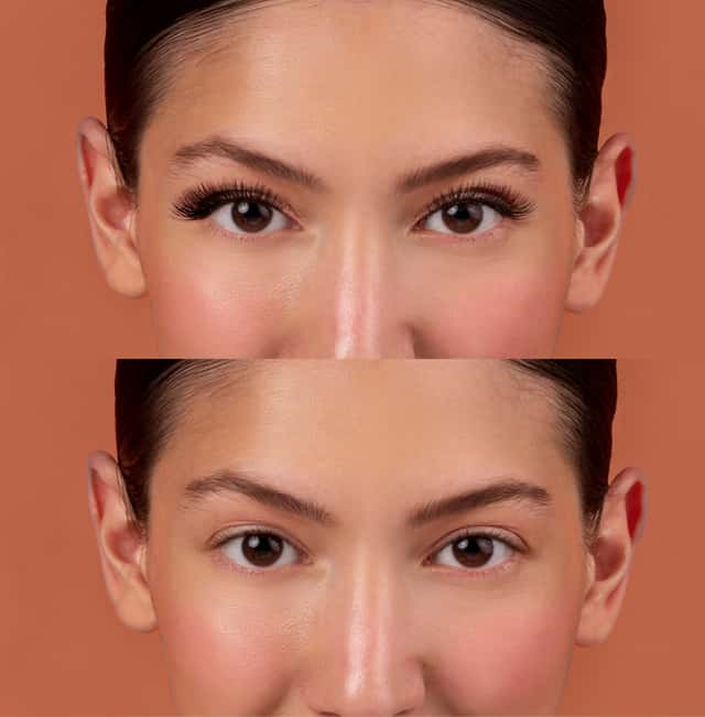 Blepharoplasty (atas +lebih rendah)