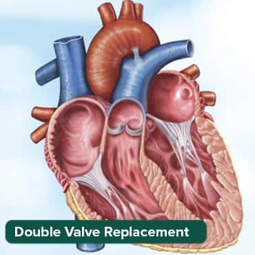 Remplacement de double valve (DVR)