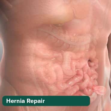 Pag-aayos ng Laparoscopic Hernia