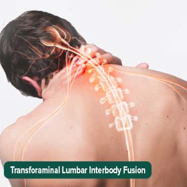 Fusi lumbal antar tubuh transforaminal (TLIF))