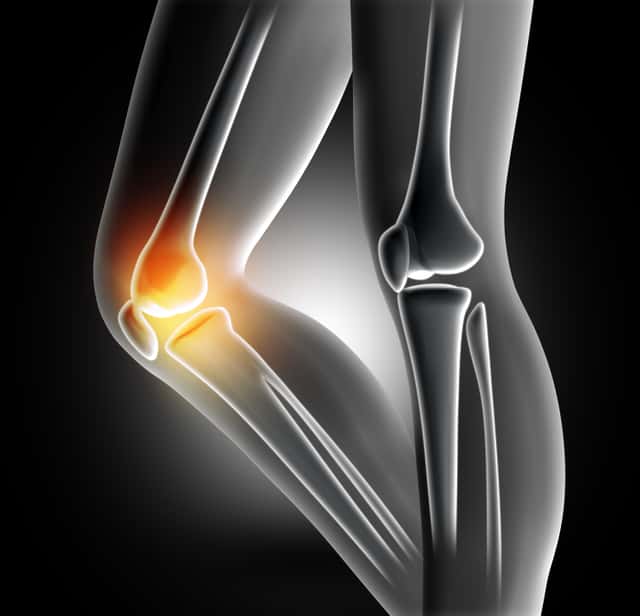 Arthroplastie totale du genou (simple)