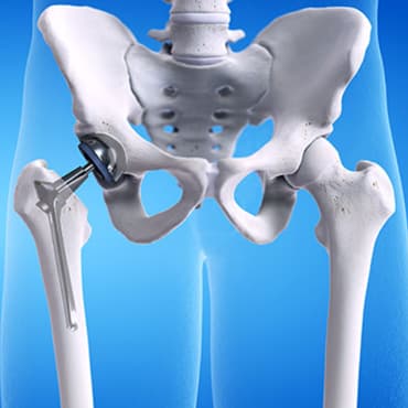 Arthroplastie totale de la hanche-U/L