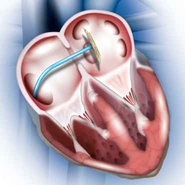 Atial Sesptal ጉድለቶች (ASD) / ventricular Sespal ጉድለቶች (VSD)