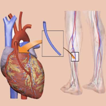 Cantuman Pintasan Arteri Koronari(CABG))