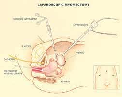 Laparoscopic Cystectomy